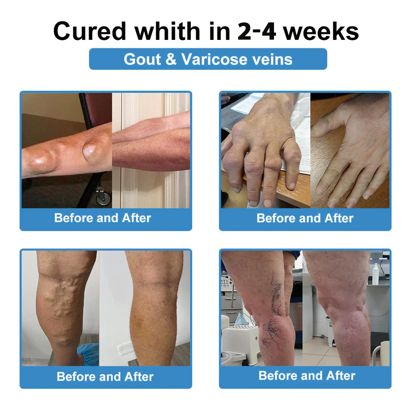 Thonesr® Nano-microneedle joint patch 4 Thonesr® Nano-microneedle joint patch