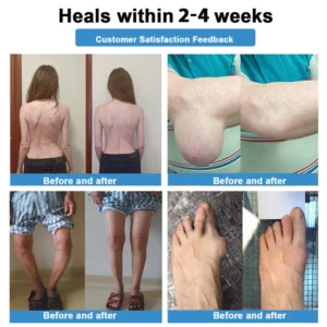 Thonesr® Nano-microneedle joint patch 15 Thonesr® Nano-microneedle joint patch