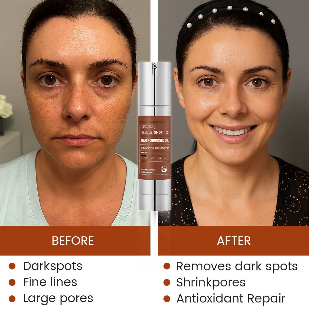 Oveallgo® Korean HerbErase Reedle Shot 100 Black Cumin Seed Oil Dark Spot Peel-Off Facial Mask 4 Oveallgo® Korean HerbErase Reedle Shot 100 Black Cumin Seed Oil Dark Spot Peel-Off Facial Mask