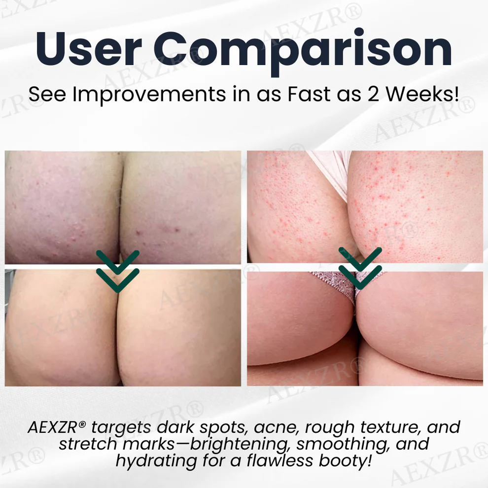 AEXZR® Butt Skin Treatment Cream 3 AEXZR® Butt Skin Treatment Cream