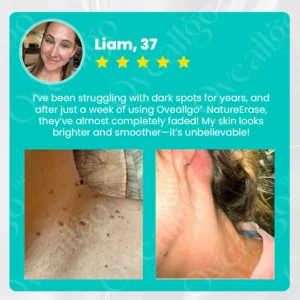 Oveallgo® PRO NatureErase Instant Mole & Spot Cream 18 Oveallgo® PRO NatureErase Instant Mole & Spot Cream