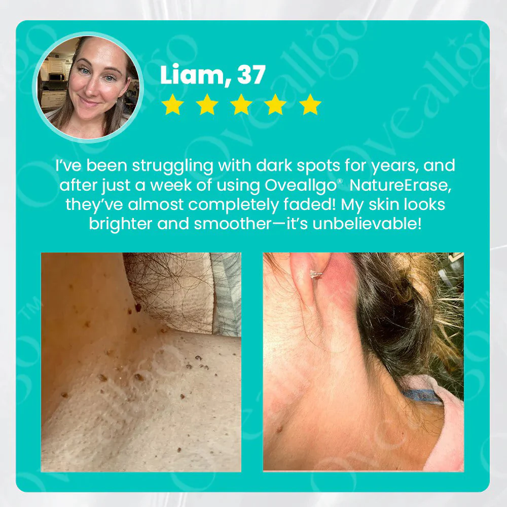 Oveallgo® PRO NatureErase Instant Mole & Spot Cream 7 Oveallgo® PRO NatureErase Instant Mole & Spot Cream