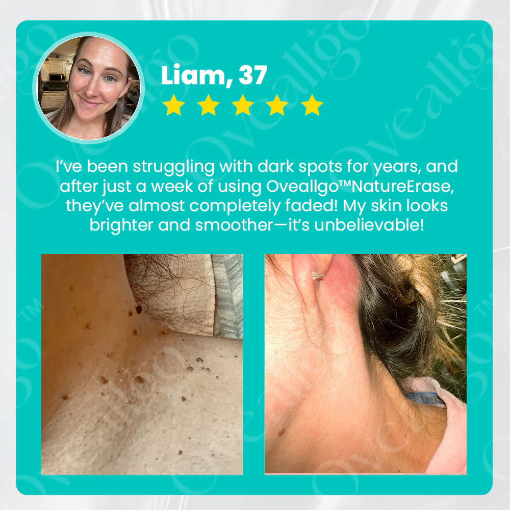 Oveallgo® NatureErase Instant Mole & Spot Removal Gel 6 Oveallgo® NatureErase Instant Mole & Spot Removal Gel