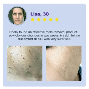 Oveallgo® Ultra Clarivine Dissolver Mole & Dark Spot Removal Bio-Gel