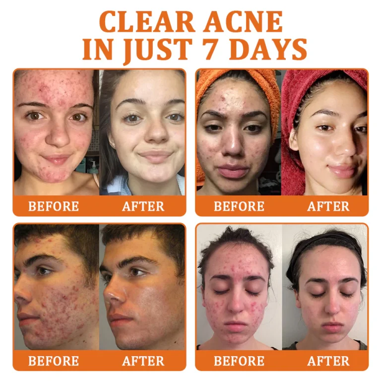 Flysmus™ Botox Bee Venom Treatment Serum Stick 6 Flysmus™ Botox Bee Venom Treatment Serum Stick