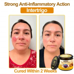 ADNOON™ Botox & Bee Venom Skin Treatment Cream