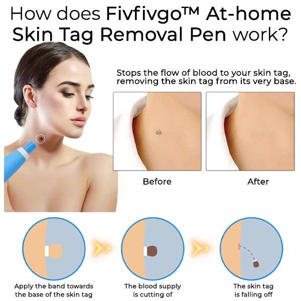 Fivfivgo™ At-home Skin Tag Removal Pen 2 Fivfivgo™ At-home Skin Tag Removal Pen