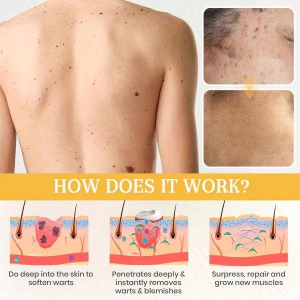 Oveallgo® DermaErase Advanced Mole & Spot Removal Gel 9 Oveallgo® DermaErase Advanced Mole & Spot Removal Gel