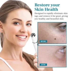 Slimoly™ LumeSkin Mole and Wart Removal Laser Pen