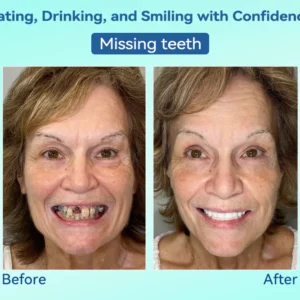 DIYSTAR™ Premium Denture 19 DIYSTAR™ Premium Denture