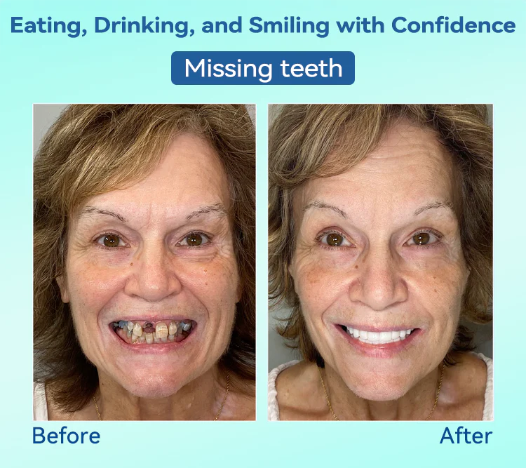 DIYSTAR™ Premium Denture 7 DIYSTAR™ Premium Denture - Image 7