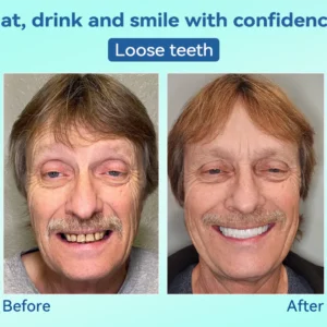 DIYSTAR™ Premium Denture 18 DIYSTAR™ Premium Denture