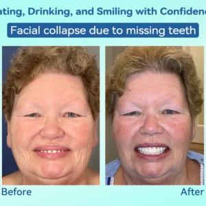 DIYSTAR™ Premium Denture 20 DIYSTAR™ Premium Denture