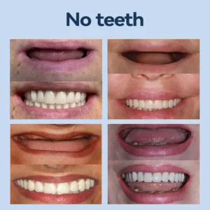 SmileFitPro® – MedicalFit Adaptive Dentures 22 SmileFitPro® – MedicalFit Adaptive Dentures