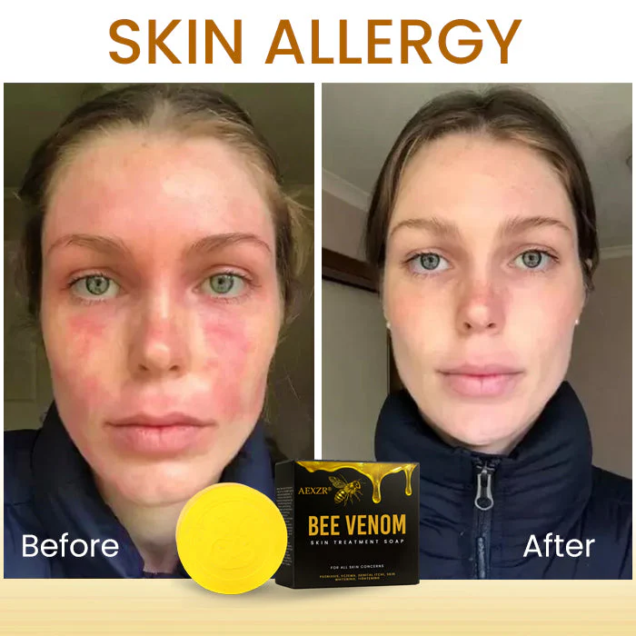 AEXZR® Bee Venom Skin Treatment Soap 7 AEXZR® Bee Venom Skin Treatment Soap