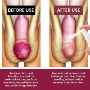 Cvreoz® Balanitis Treatment Spray