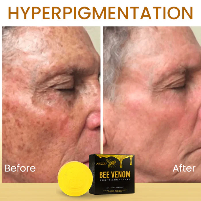 AEXZR® Bee Venom Skin Treatment Soap 11 AEXZR® Bee Venom Skin Treatment Soap