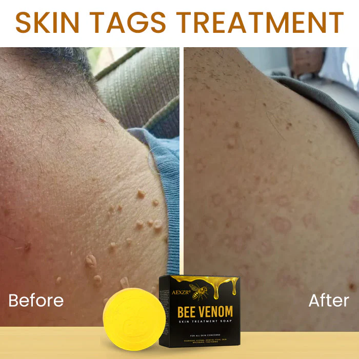 AEXZR® Bee Venom Skin Treatment Soap 9 AEXZR® Bee Venom Skin Treatment Soap