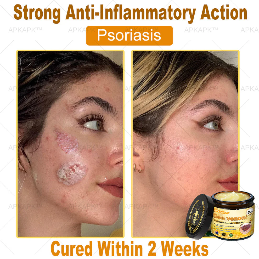 APKAPK™ Bee Venom Skin Treatment Cream 9 APKAPK™ Bee Venom Skin Treatment Cream