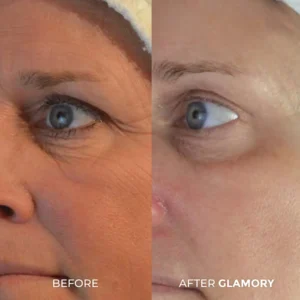 Glamory MicroLift System-Erase Years of Aging at Home in Just 5 Minutes