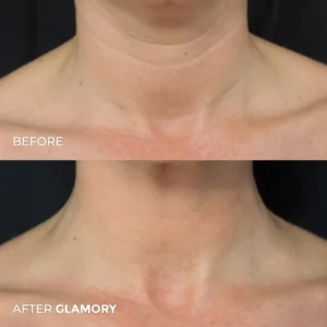 Glamory MicroLift System-Erase Years of Aging at Home in Just 5 Minutes