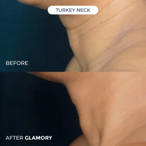 Glamory MicroLift System-Erase Years of Aging at Home in Just 5 Minutes