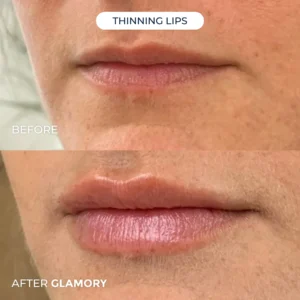 Glamory MicroLift System-Erase Years of Aging at Home in Just 5 Minutes