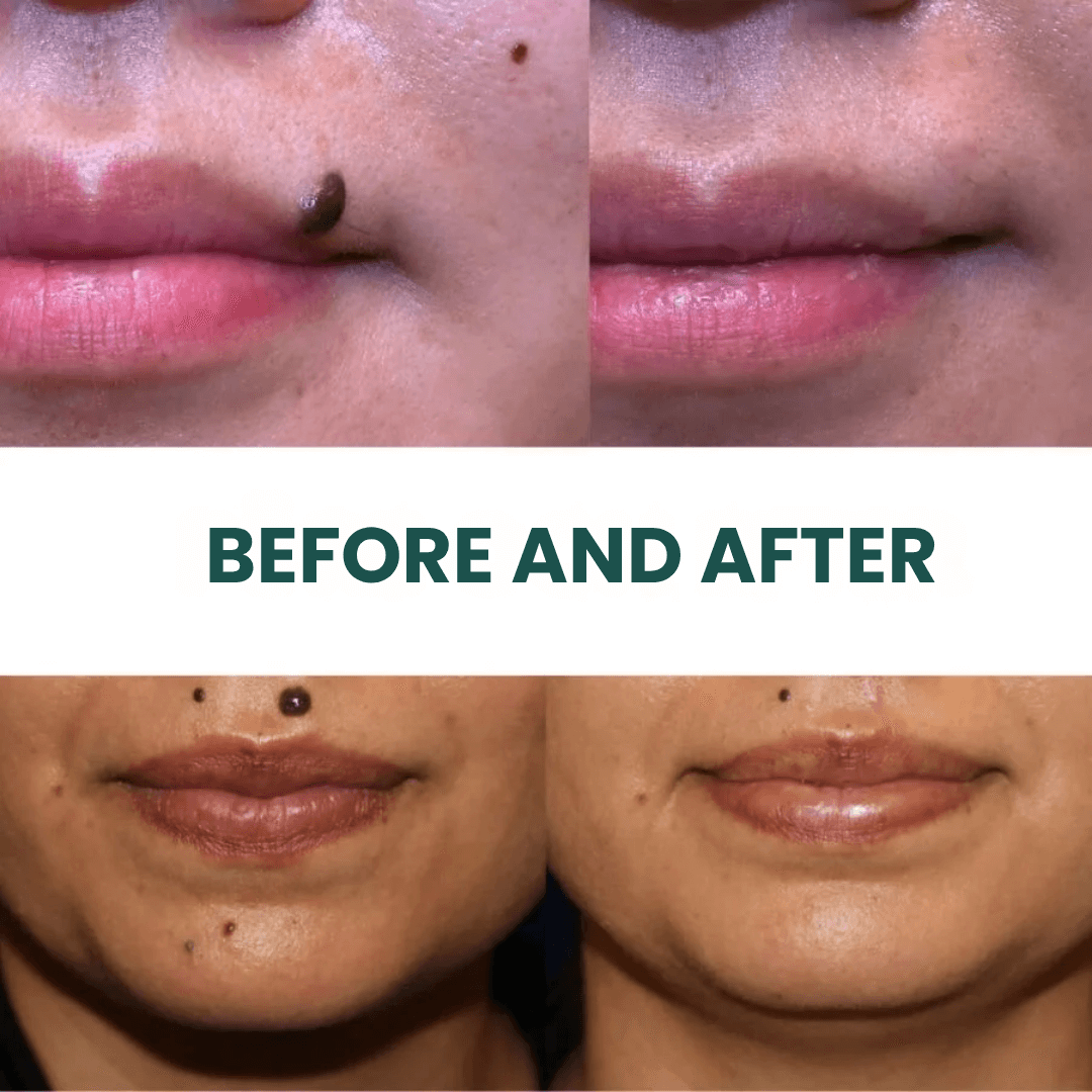 SilkSkin™ | Clinically Proven to Remove 97% of Moles, Warts & Blemishes 7 SilkSkin™ | Clinically Proven to Remove 97% of Moles, Warts & Blemishes