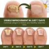 NailCure™ Fungal Nail Drops 4 NailCure™ Fungal Nail Drops