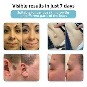 Cougex® Non-invasive Mole & Wart Removal Laser Pen