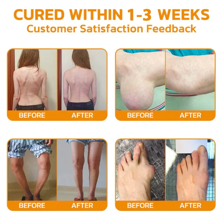 flysmus™ Bee-Venom Pain-Relief Bone Healing Cream 3 flysmus™ Bee-Venom Pain-Relief Bone Healing Cream