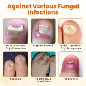 Timilk® FungiBee Advanced Nail Repair Spray 17 Timilk® FungiBee Advanced Nail Repair Spray