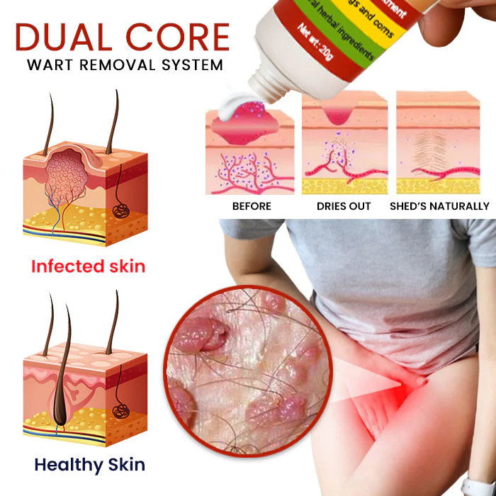 Cvreoz® FemGenital Wart Remover Cream 3 Cvreoz® FemGenital Wart Remover Cream