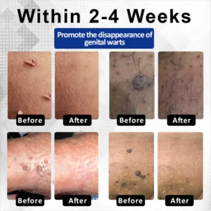 Fivfivgo® ManGuard HPV WART Healing Cream 6 Fivfivgo® ManGuard HPV WART Healing Cream