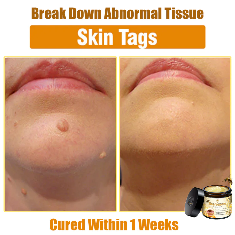 Oveallgo™ Bee Venom Skin Treatment Cream 11 Oveallgo™ Bee Venom Skin Treatment Cream - Image 11