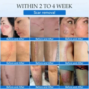 Jasseem® Non-Invasive Mole & Wart Laser Removal Pen