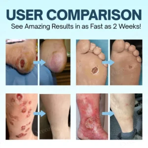 Cvreoz® Diabetes Treatment Cream 9 Cvreoz® Diabetes Treatment Cream