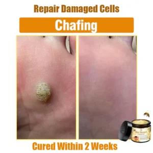 Oveallgo™ Bee Venom Skin Treatment Cream 22 Oveallgo™ Bee Venom Skin Treatment Cream