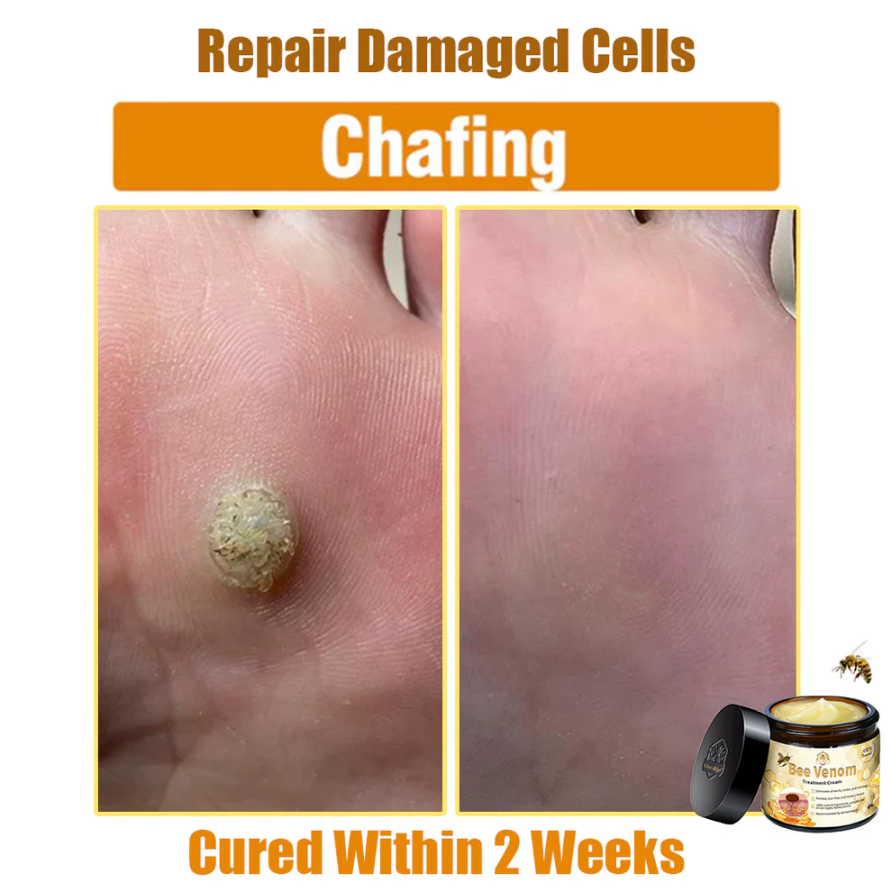 Oveallgo™ Bee Venom Skin Treatment Cream 10 Oveallgo™ Bee Venom Skin Treatment Cream - Image 10