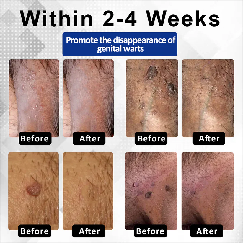 Fivfivgo® ManGuard HPV WART Healing Cream 3 Fivfivgo® ManGuard HPV WART Healing Cream