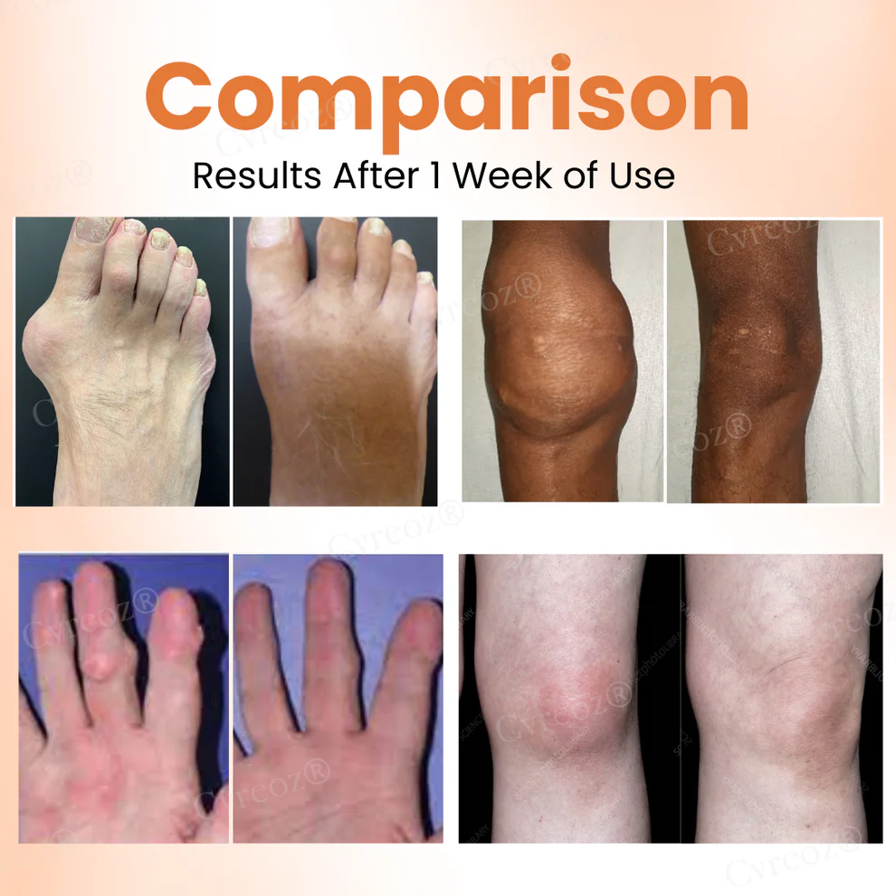 Cvreoz® Colchicine Nano-Needles Patches for Gout Care 2 Cvreoz® Colchicine Nano-Needles Patches for Gout Care