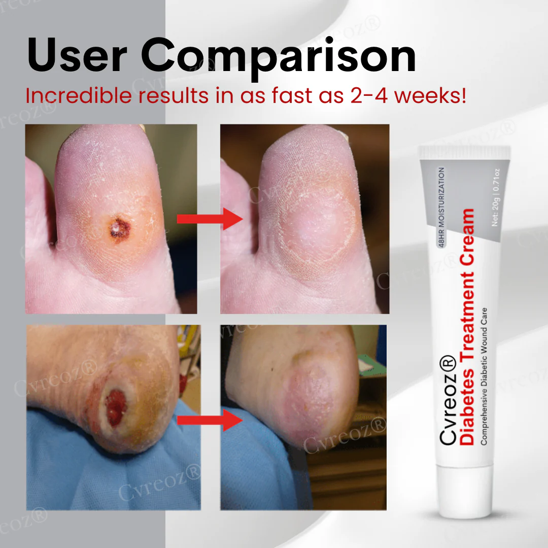 Cvreoz® Diabetes Treatment Cream 2 Cvreoz® Diabetes Treatment Cream
