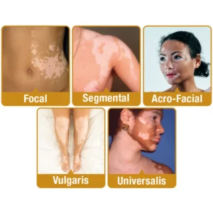 Dobshow™ BeeVenom Vitiligo Treatment Cream 16 Dobshow™ BeeVenom Vitiligo Treatment Cream
