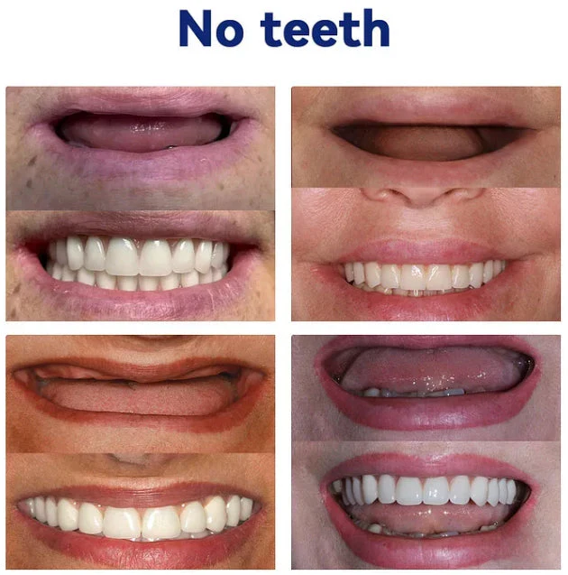 Bikenda®Advanced Full Denture Set 6 Bikenda®Advanced Full Denture Set - Image 6