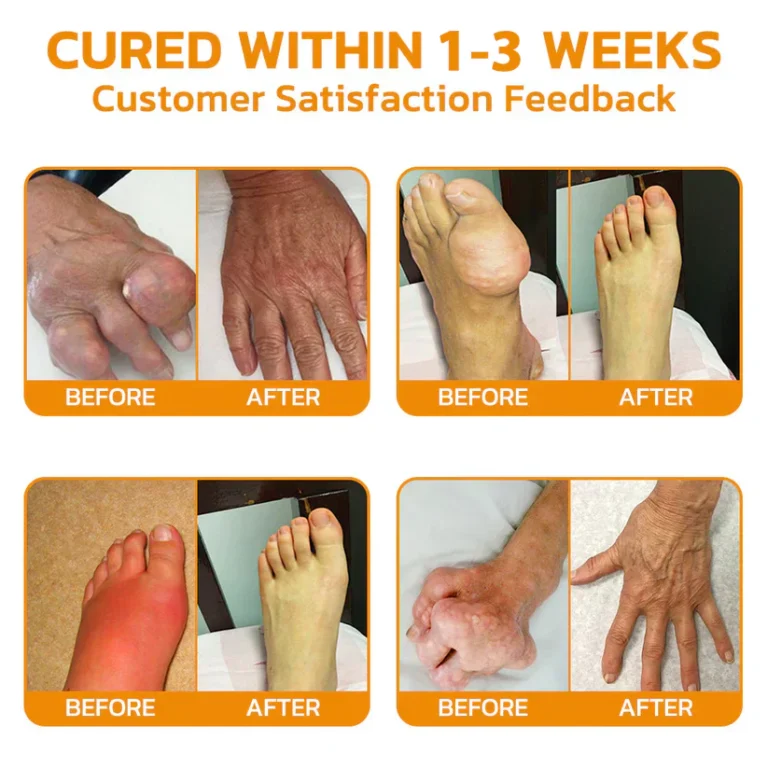 flysmus™ Bee-Venom Pain-Relief Bone Healing Cream 2 flysmus™ Bee-Venom Pain-Relief Bone Healing Cream