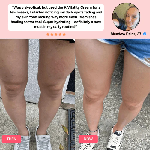 SheVitality™ Cellulite Relief Kit 14 SheVitality™ Cellulite Relief Kit - Image 14