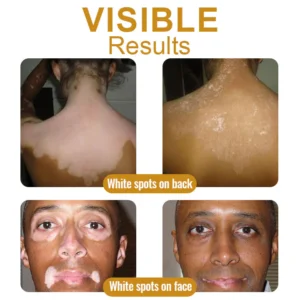 Dobshow™ BeeVenom Vitiligo Treatment Cream 23 Dobshow™ BeeVenom Vitiligo Treatment Cream