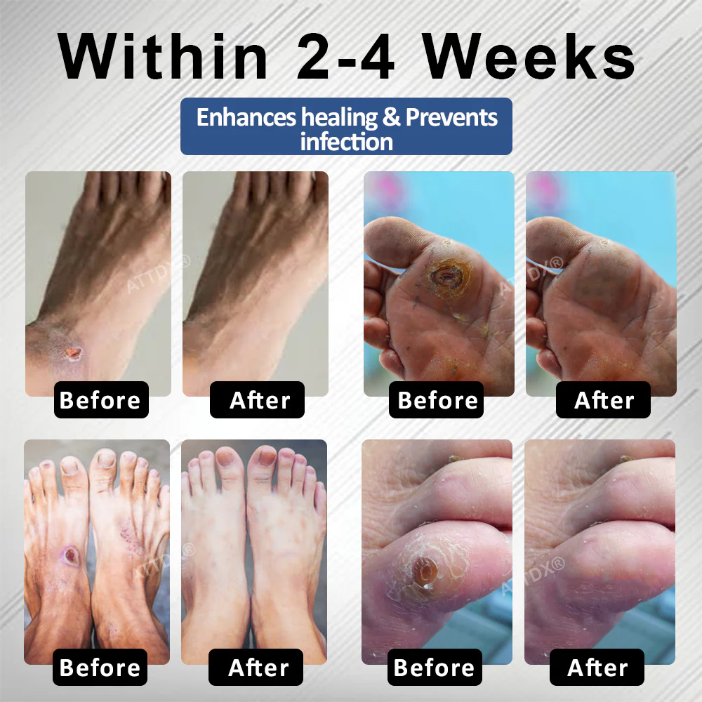 ATTDX® Diabetes Foot Guard Fast Recovery Spray 3 ATTDX® Diabetes Foot Guard Fast Recovery Spray - Image 3