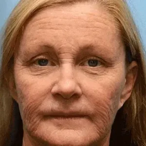 Kisshi™ Botox Bee Venom Wrinkle Removal Cream