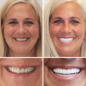 NESLEMY™ Advanced Customized Full Denture Set 16 NESLEMY™Advanced Customized Full Denture Set